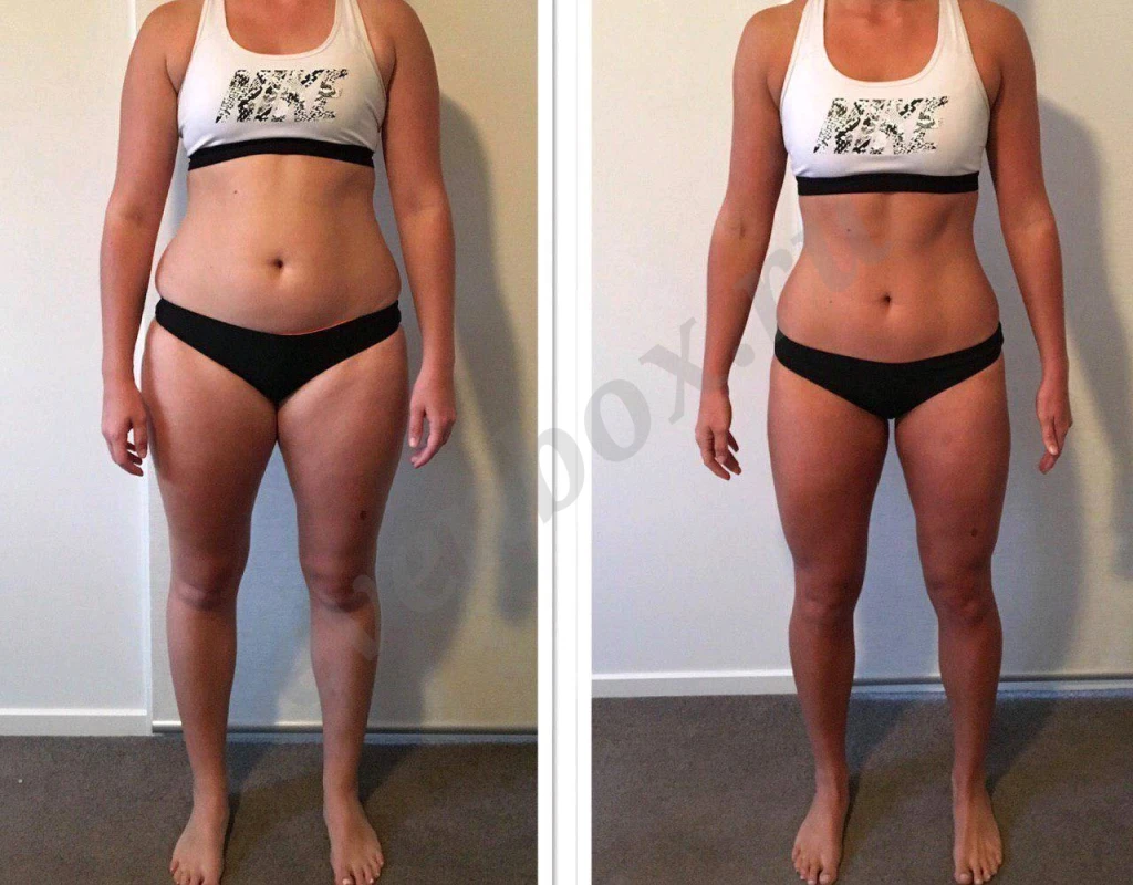 Процедуры для похудения, эпиляции, увеличение губ и не только