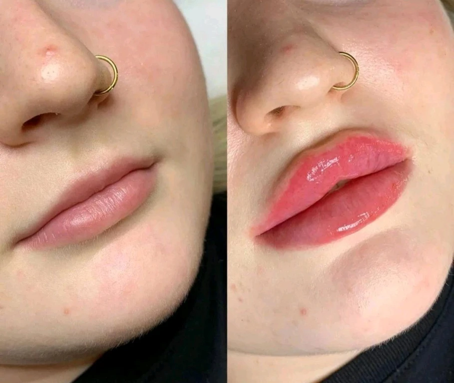 Увеличение губ/Джоли/пилинги/ботокс