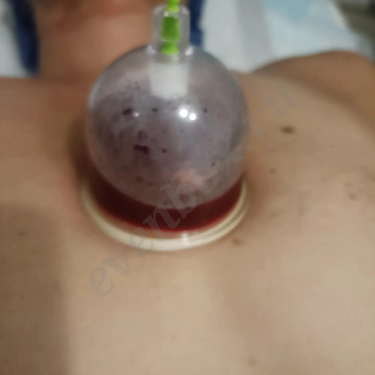 Массаж хиджама