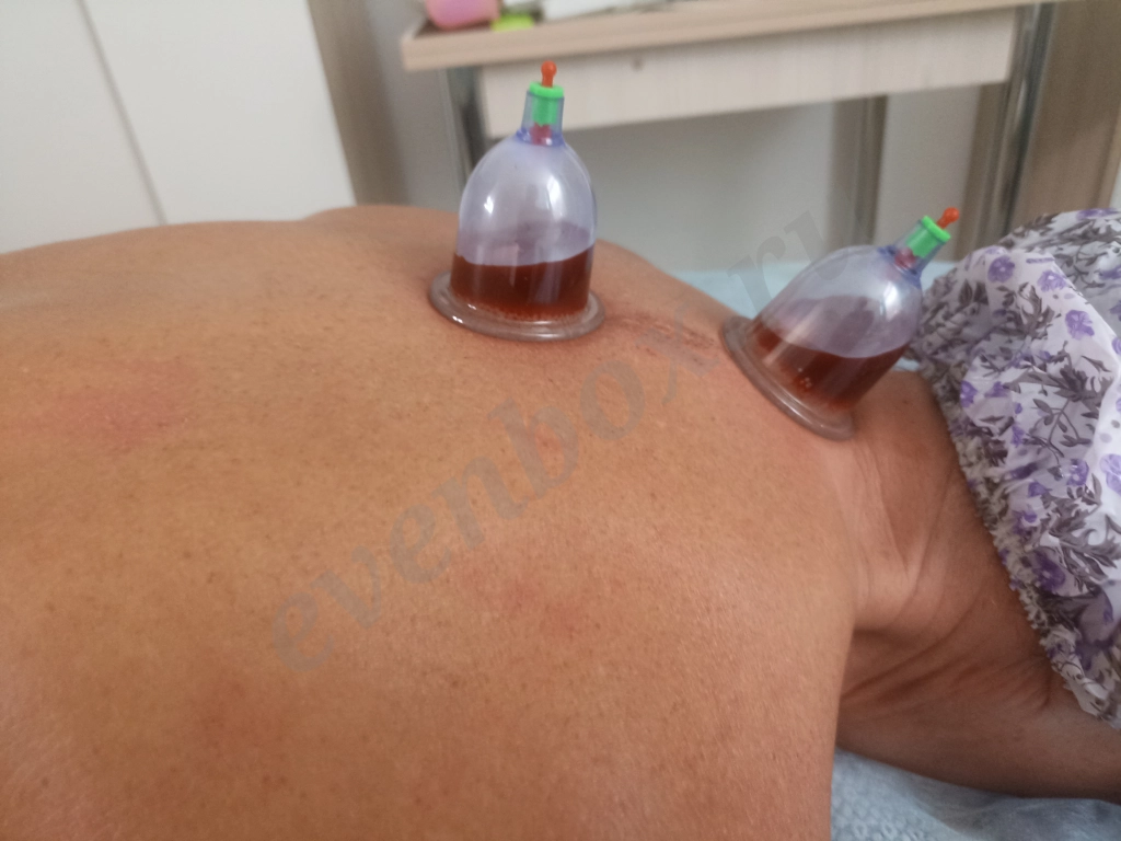 Массаж хиджама