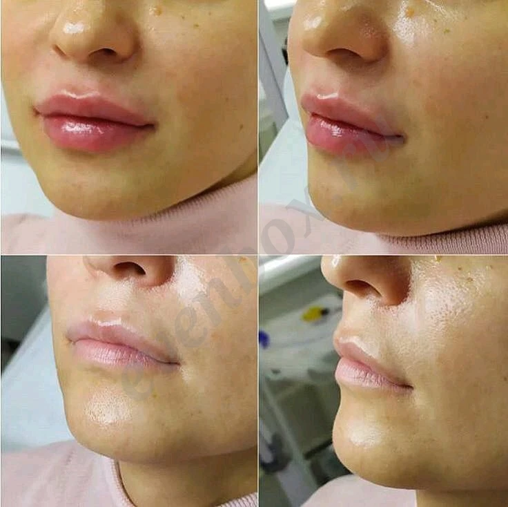 Процедуры для похудения, эпиляции, увеличение губ и не только