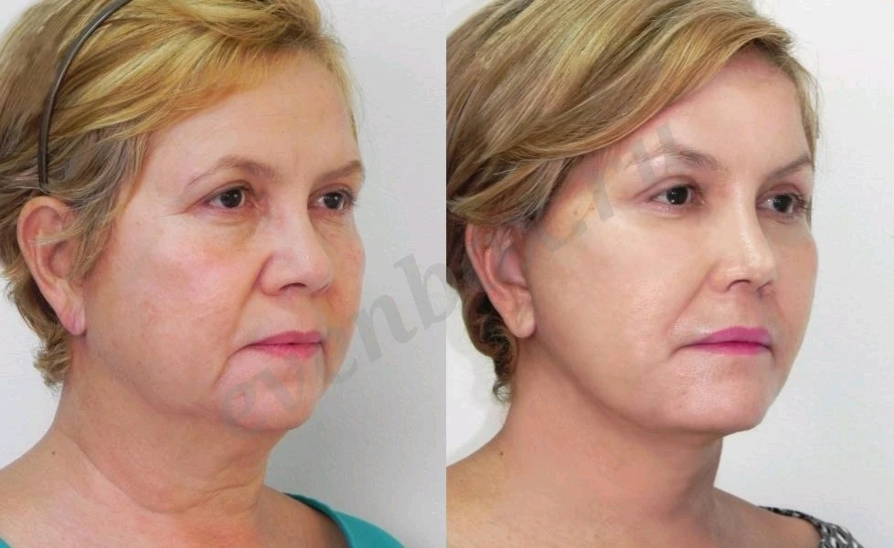 Smas- лифтинг