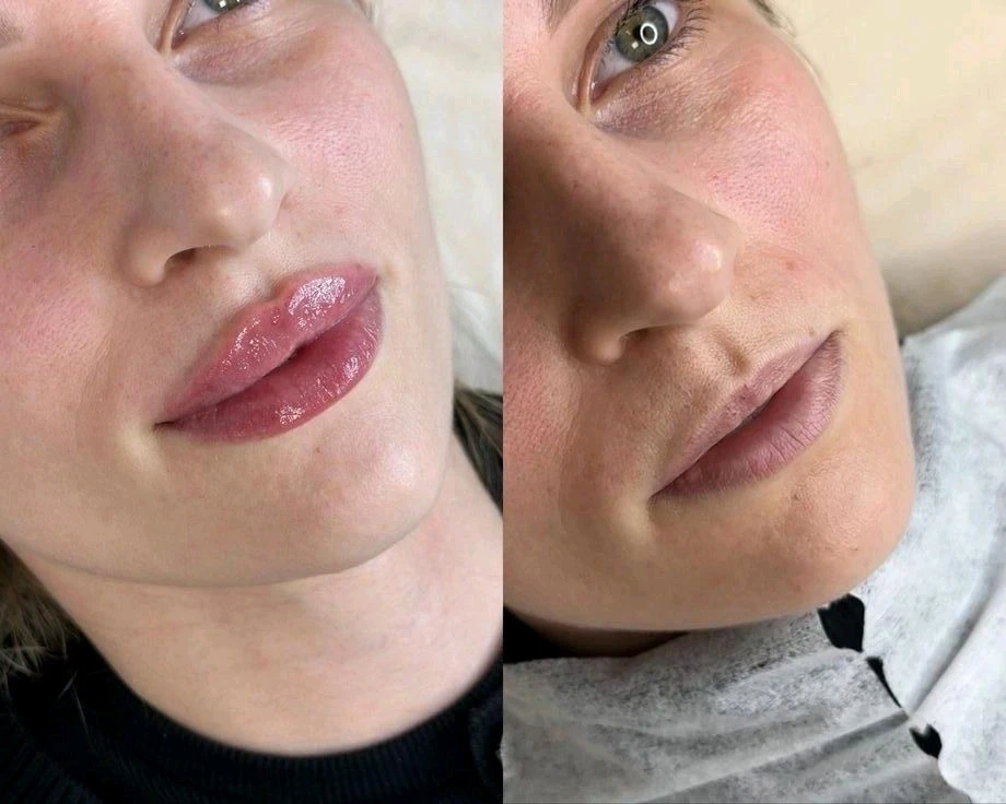 Увеличение губ/Джоли/пилинги/ботокс