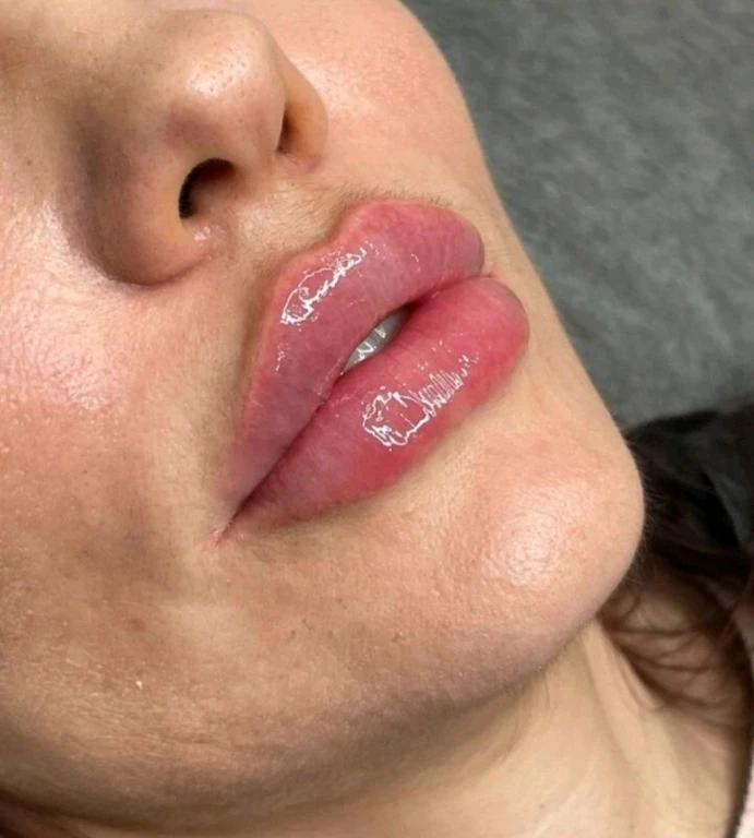 Увеличение губ/Джоли/пилинги/ботокс