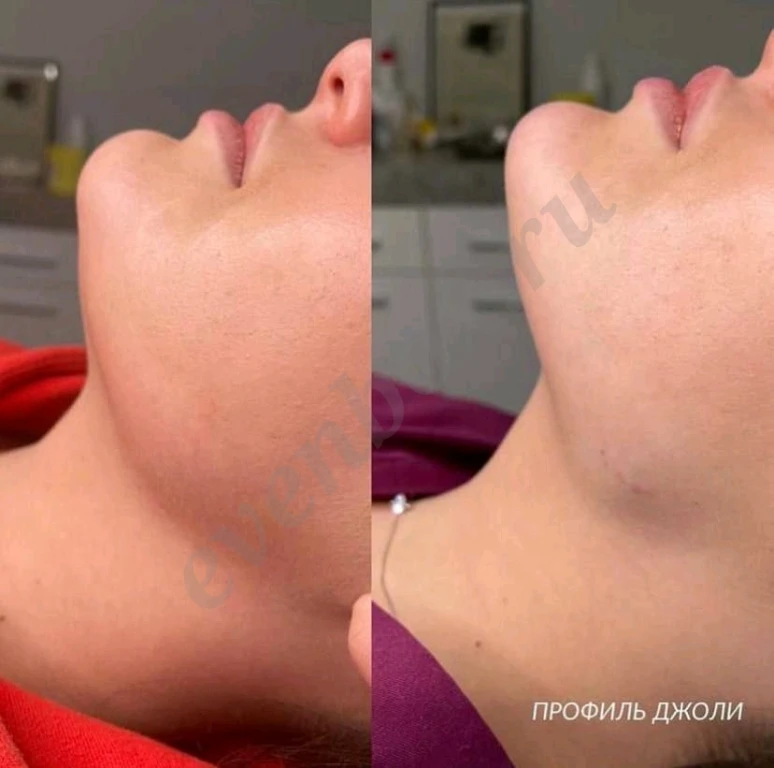 Процедуры для похудения, эпиляции, увеличение губ и не только