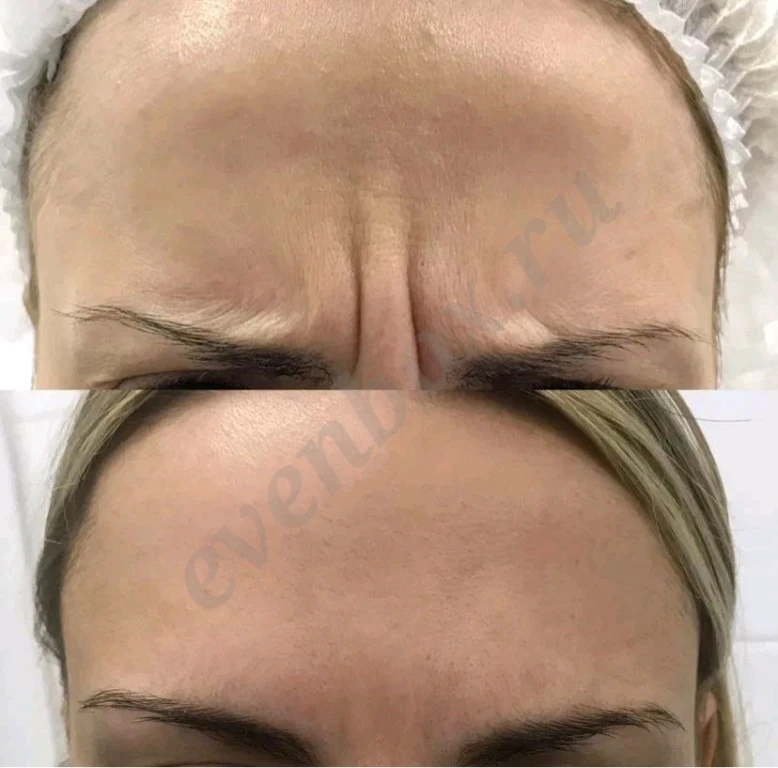 Процедуры для похудения, эпиляции, увеличение губ и не только