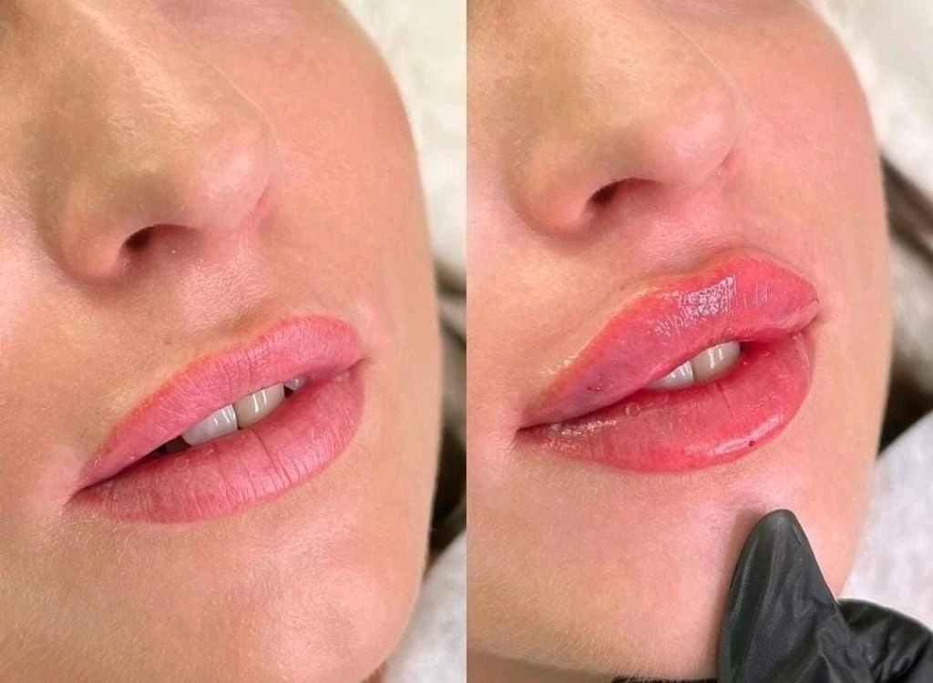 Увеличение губ/Джоли/пилинги/ботокс