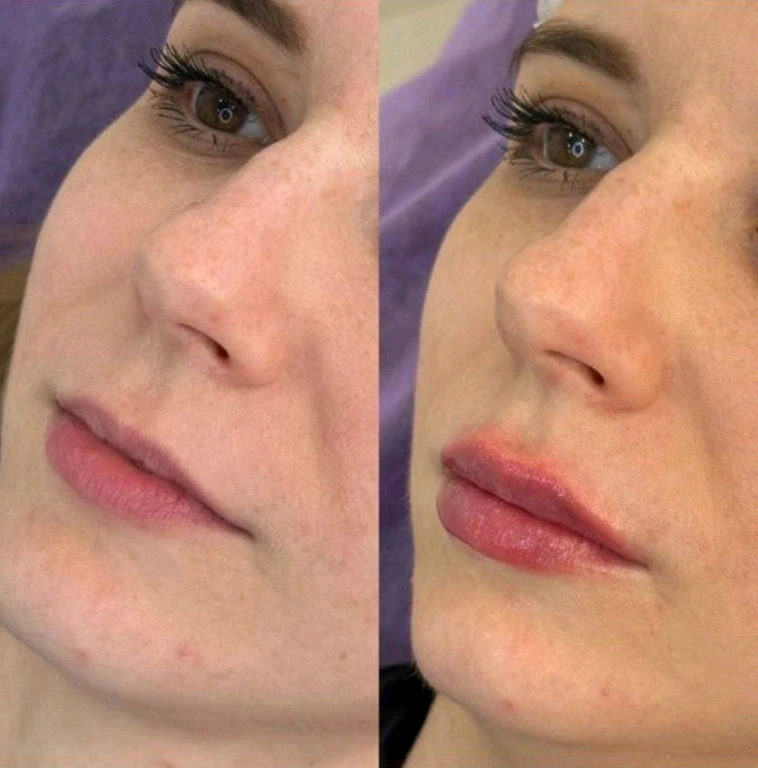 Увеличение губ/Джоли/пилинги/ботокс